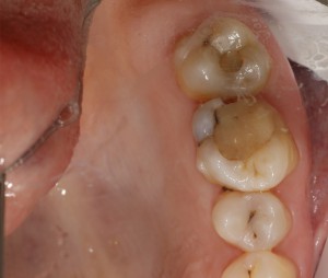 Зубы с кариесом под старыми пломбами