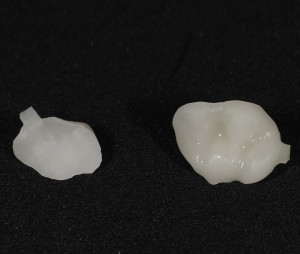 Изготовление керамических вкладок, точно повторяющих поверхность зуба
