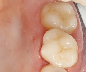 Зубы восстановленные керамическими вкладками